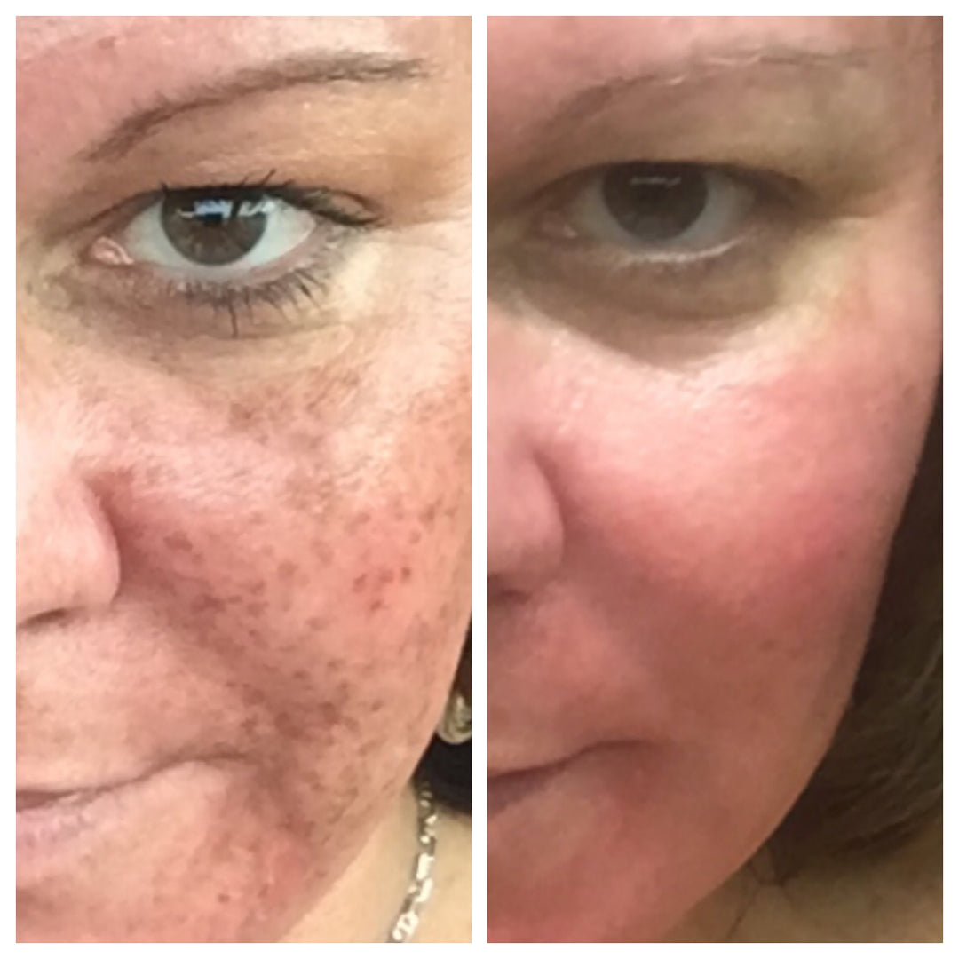 Before & After Photos of Actual Patient | Level 3 Transformation Chemical Peel at Clevens Face & Body Specialists in Melbourne, FL