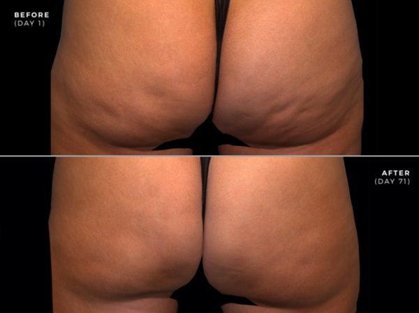 Actual Patient Before & After Photos of Qwo Cellulite Treatment